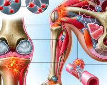 Qué tan inflamatorio es Propionato de drostanolona para las articulaciones